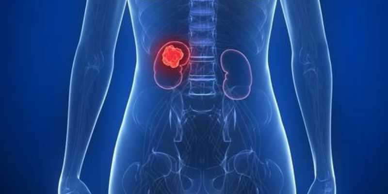 Kidney Cancer Treatment Cost in Dubai