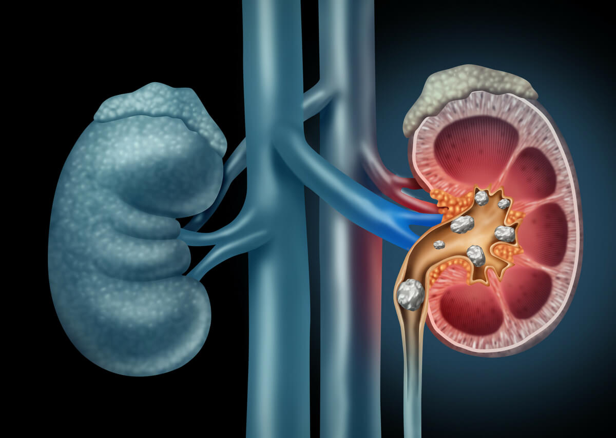 Kidney Stone Treatment