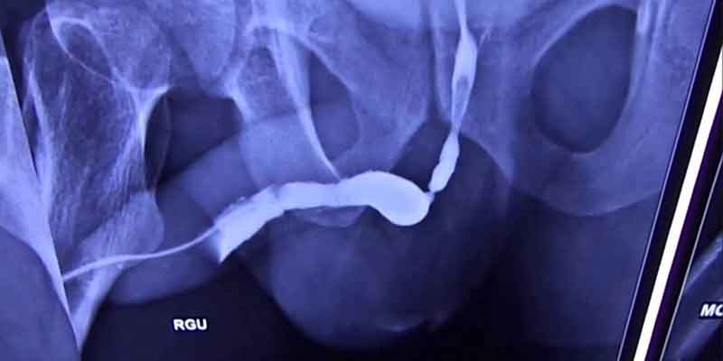Stricture Urethra Treatment in Dubai